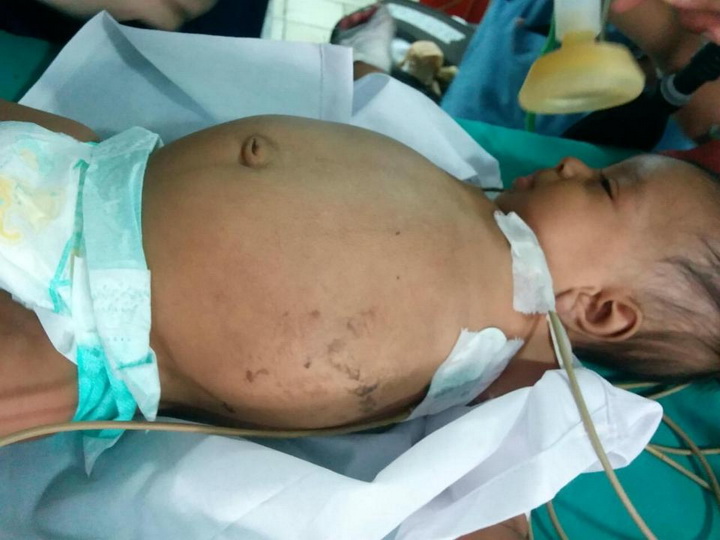 В Индии врачи извлекли из трехмесячного младенца его близнеца-паразита – ФОТО