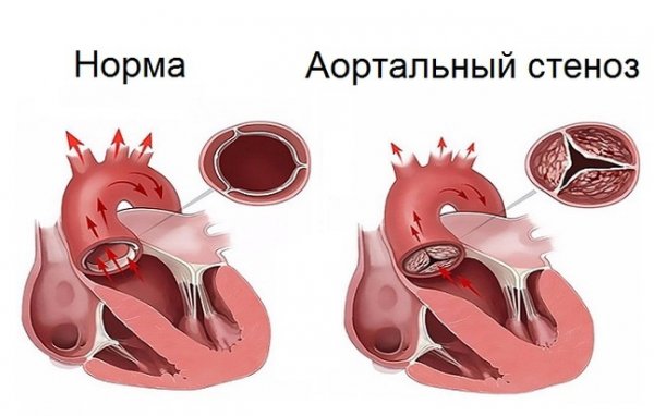 Аортальный стеноз