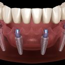 Имплантация - эффективный и безболезненный способ лечения частичной утраты зубов