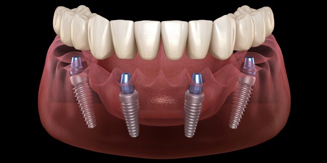 Имплантация - эффективный и безболезненный способ лечения частичной утраты зубов